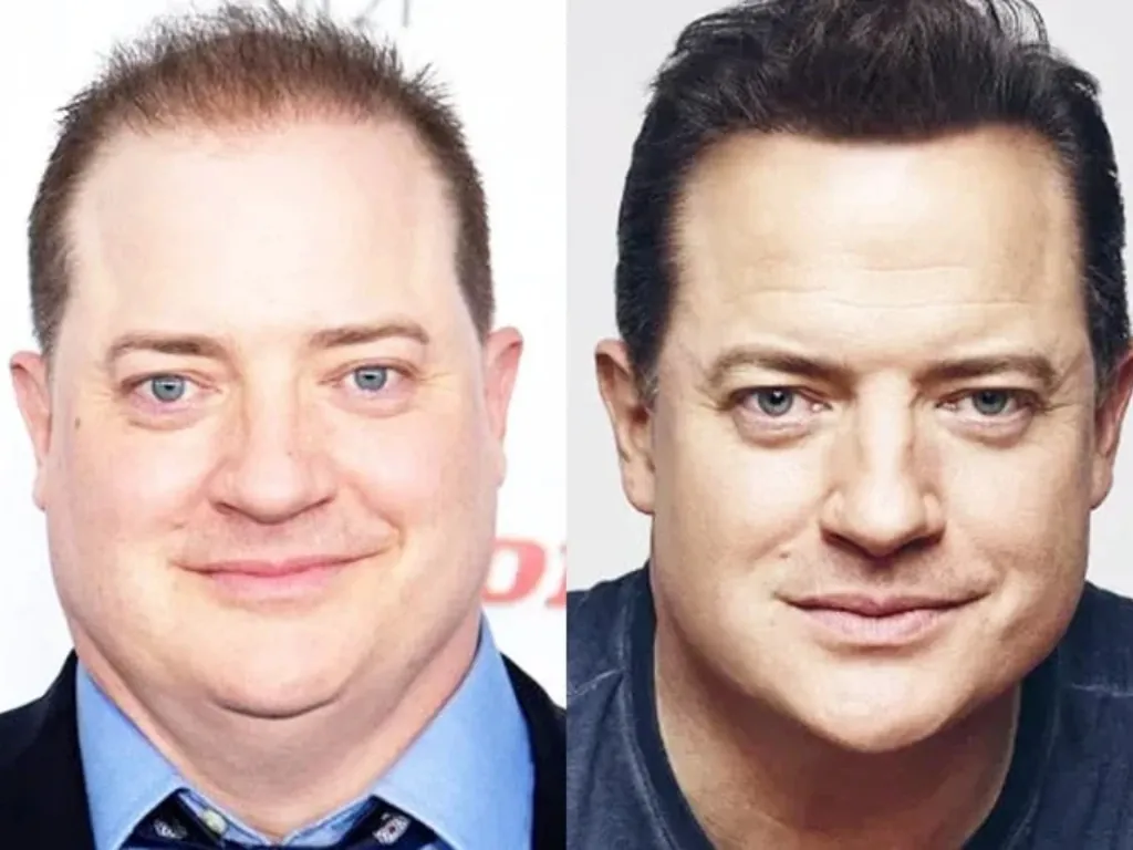 Hollywood’s Hair Secrets: Celebrities Who Wear Wigs Regularly 7 Brendan Fraser stands as an example of male celebrities who wear wigs due to hair loss